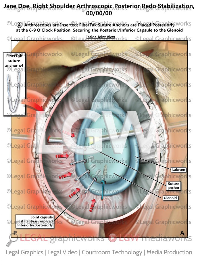 Right Shoulder Arthroscopic Posterior Redo Stabilization