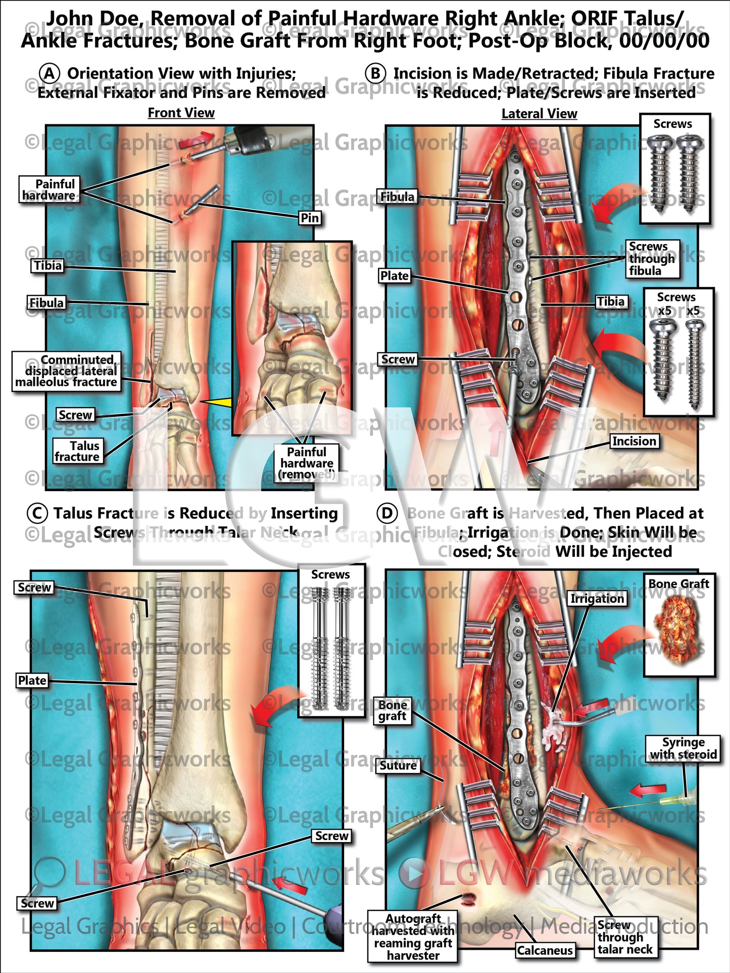 Removal of Painful Hardware Right Ankle; ORIF Talus/Ankle Fractures; Bone Graft From Right Foot; Post-Op Block