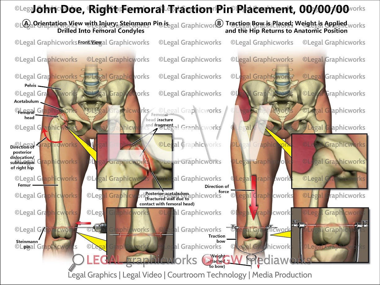 Right Femoral Traction Pin Placement