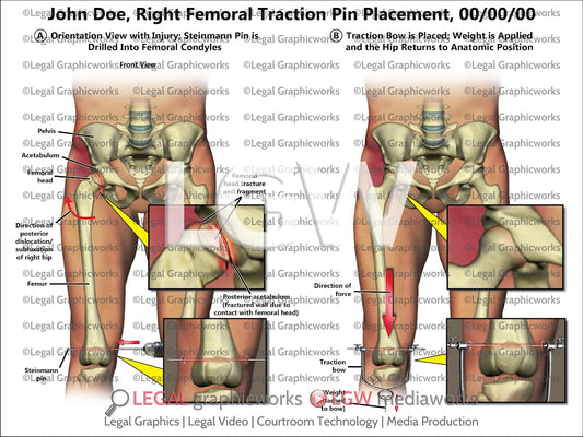 Right Femoral Traction Pin Placement