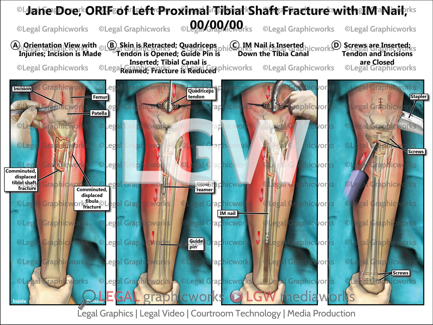 ORIF of Left Proximal Tibial Shaft Fracture with IM Nail
