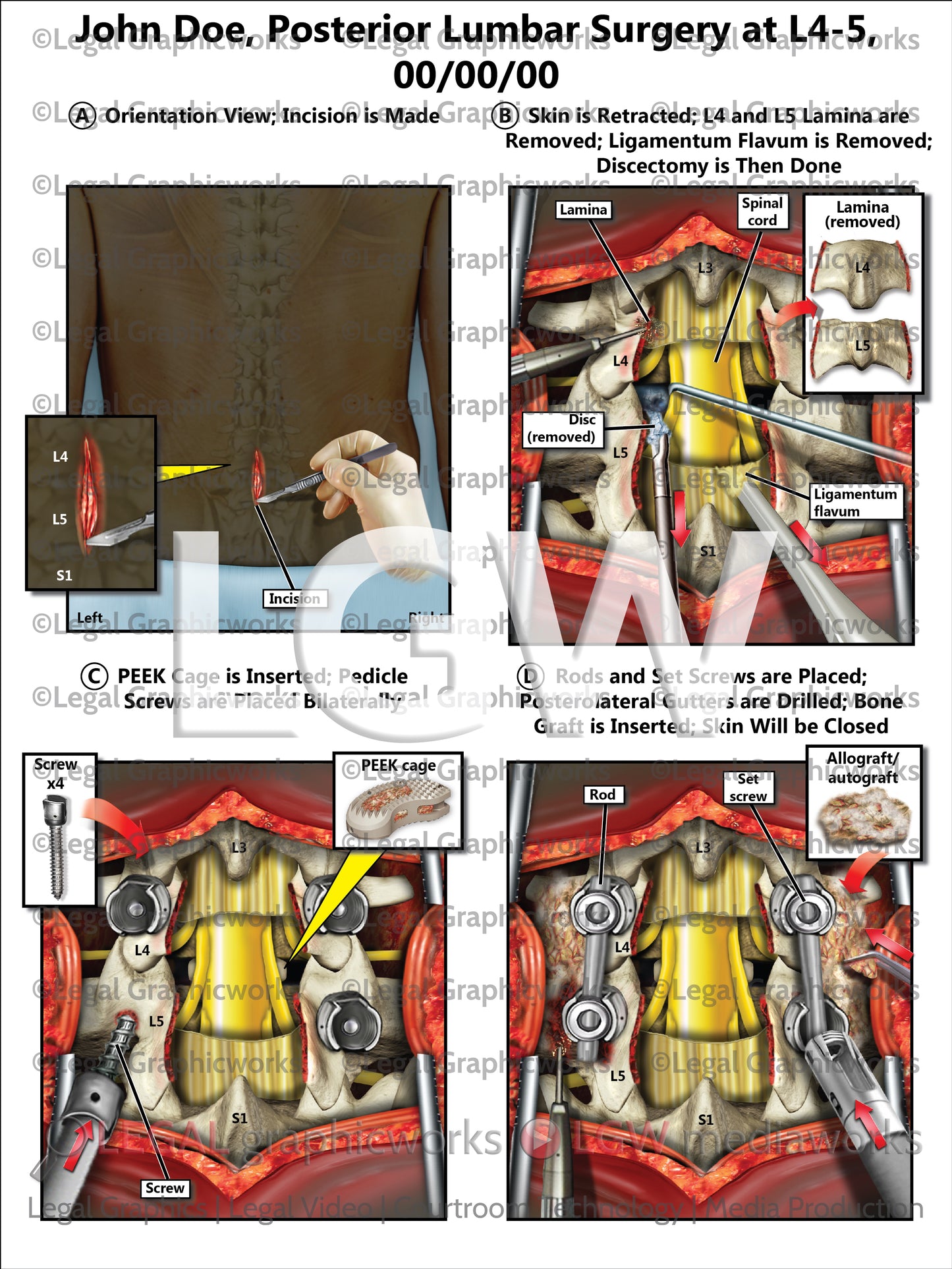 Posterior Lumbar Surgery at L4-5