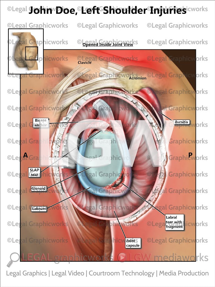 Left Shoulder Injuries