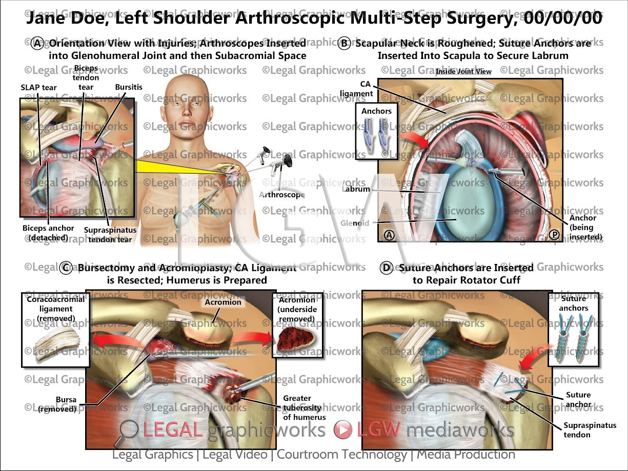 Left Shoulder Arthroscopic Multi-Step Surgery