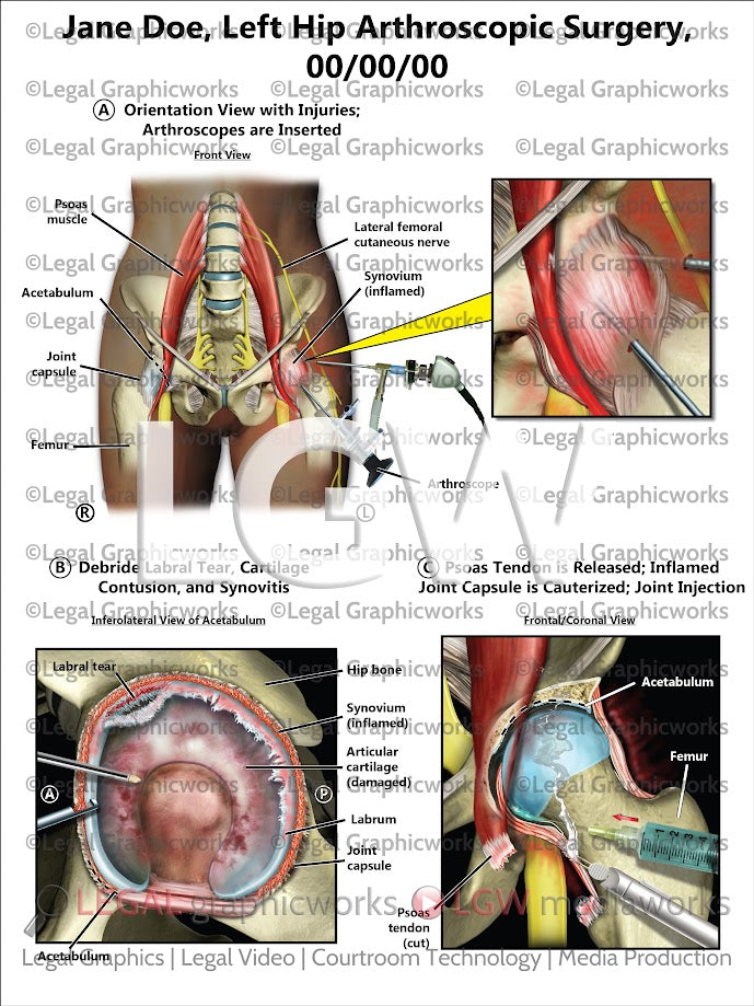Left Hip Arthroscopic Surgery
