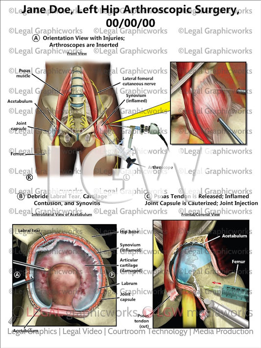 Left Hip Arthroscopic Surgery