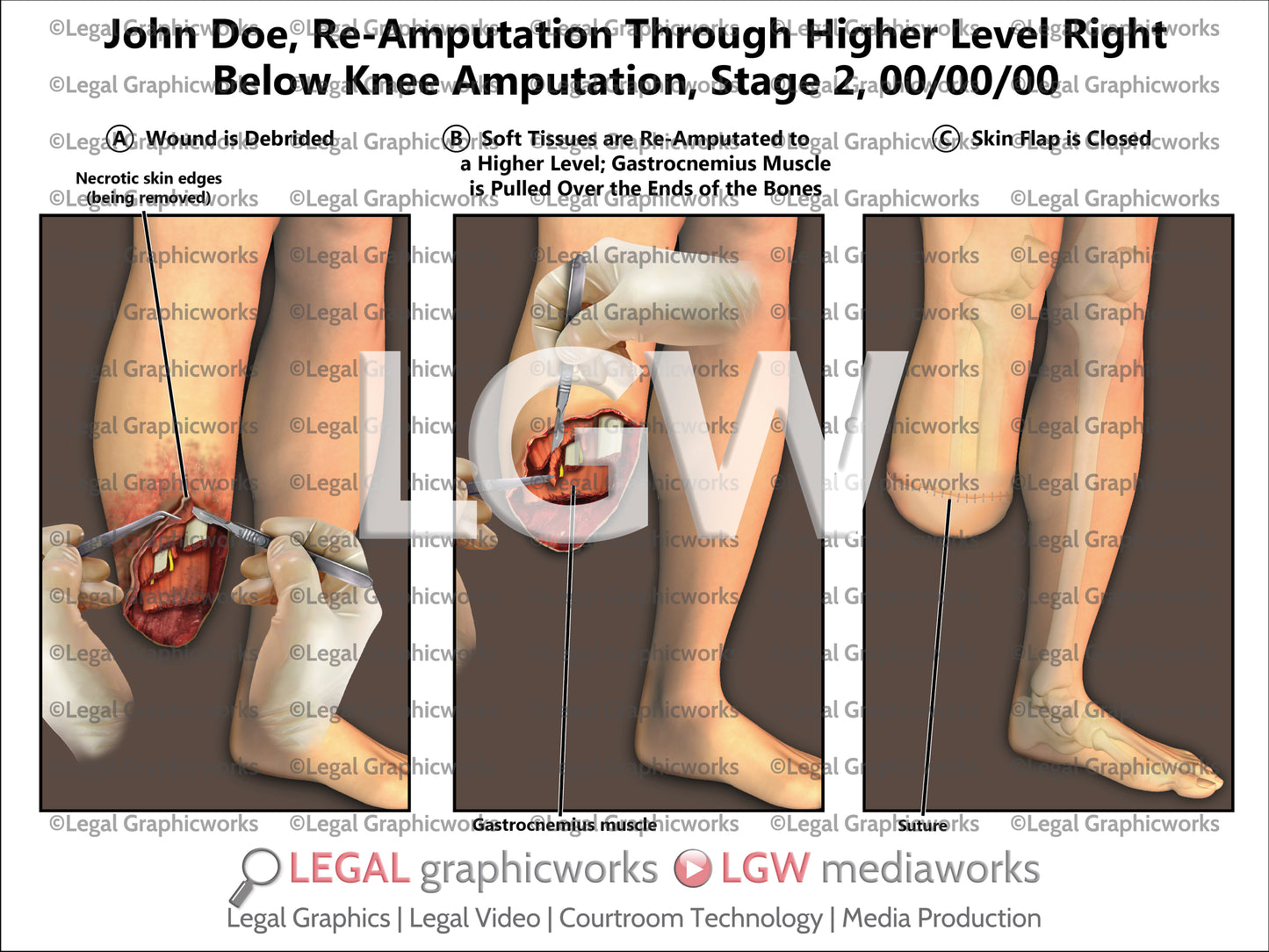 Re-Amputation Through Higher Level Right Below Knee Amputation, Stage 2