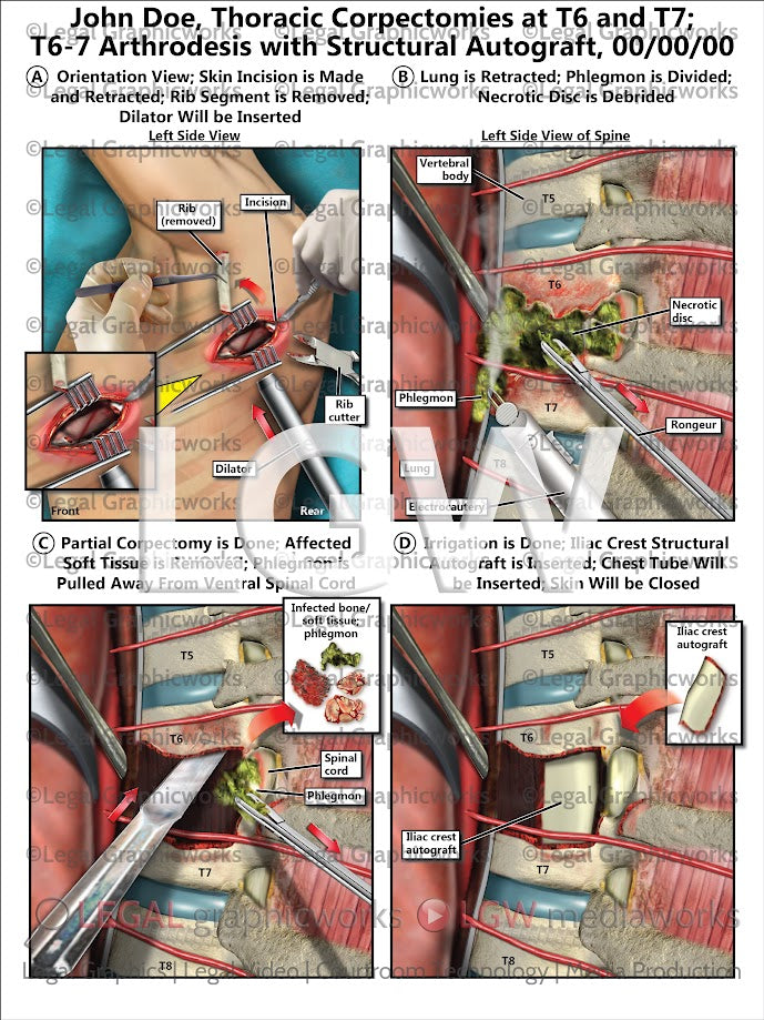 Thoracic Corpectomies at T6 and T7; T6-7 Arthrodesis with Structural Autograft