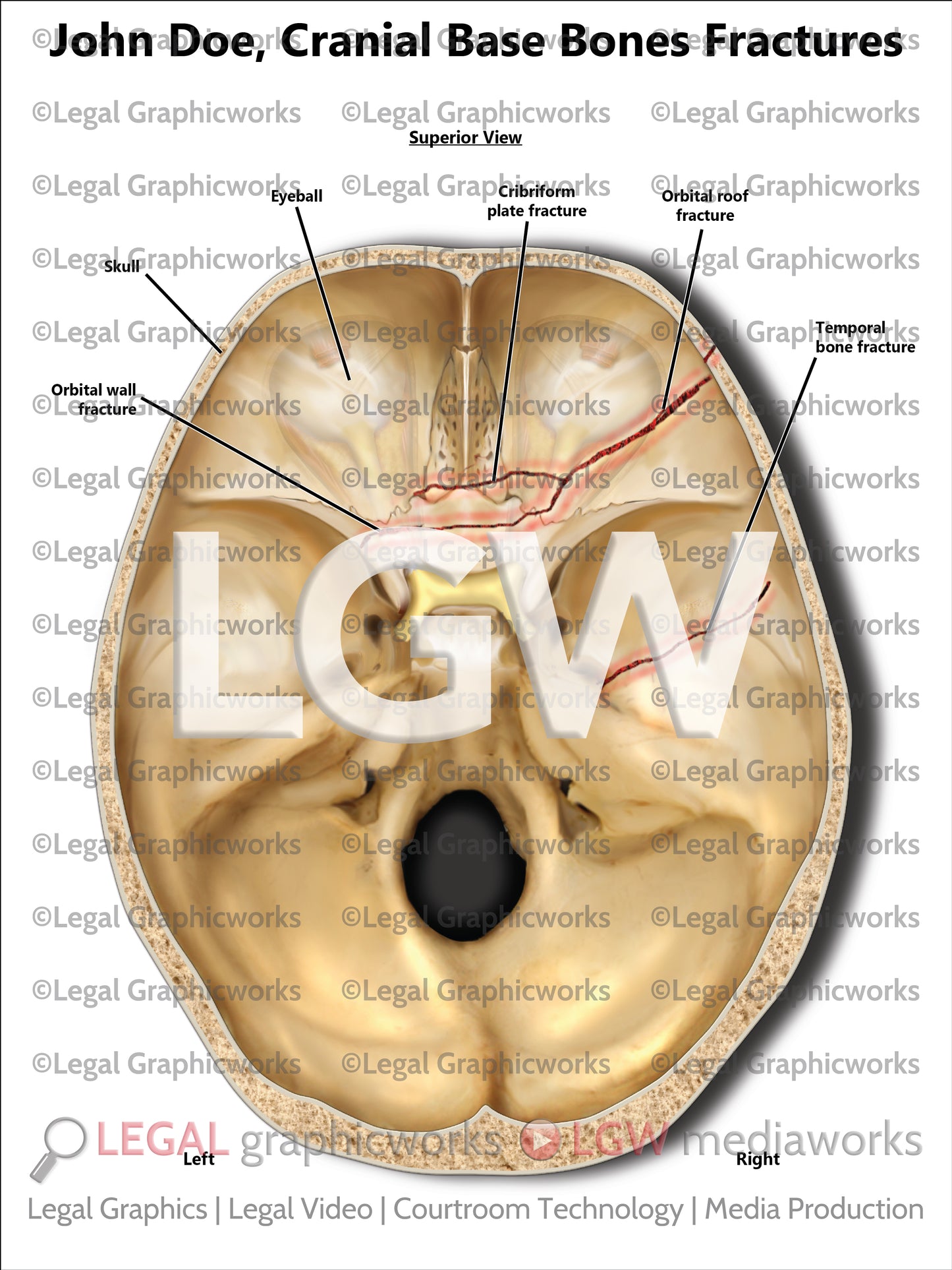 Cranial Base Bones Fractures