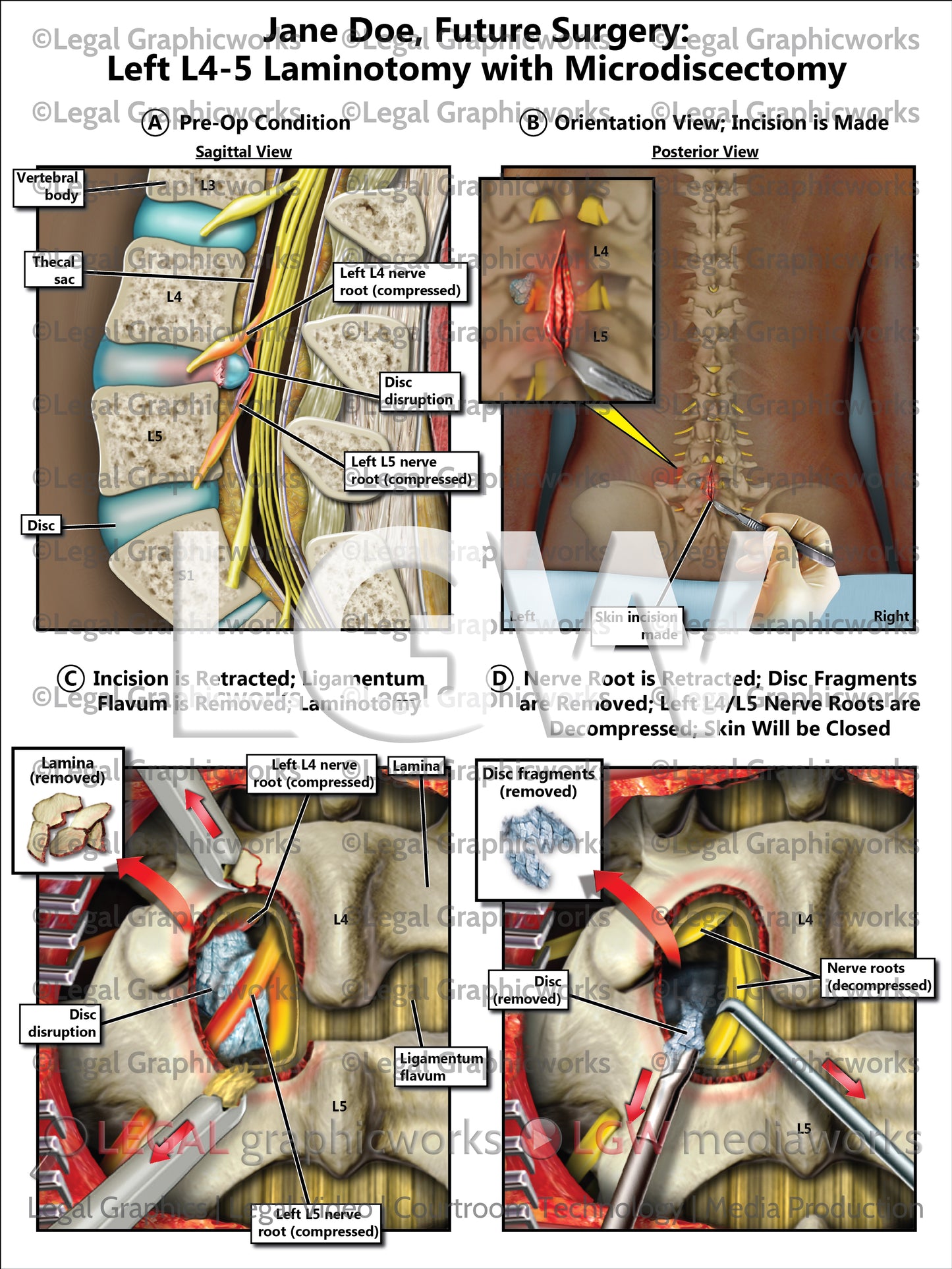 Future Surgery: Left L4-5 Laminotomy with Microdiscectomy