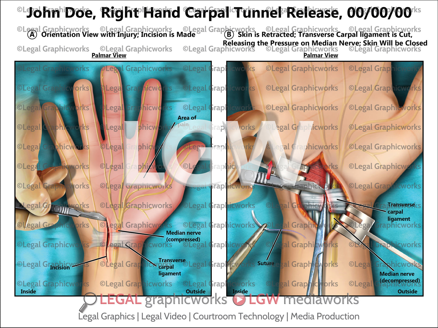 Right Hand Carpal Tunnel Release