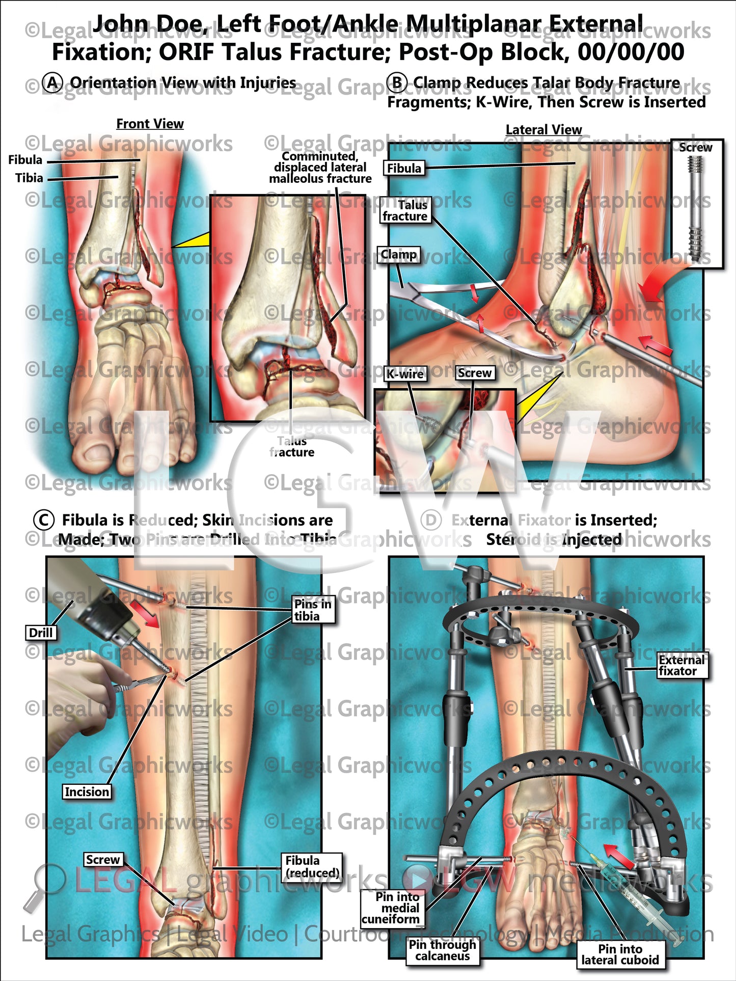 Left Foot/Ankle Multiplanar External Fixation; ORIF Talus Fracture; Post-Op Block