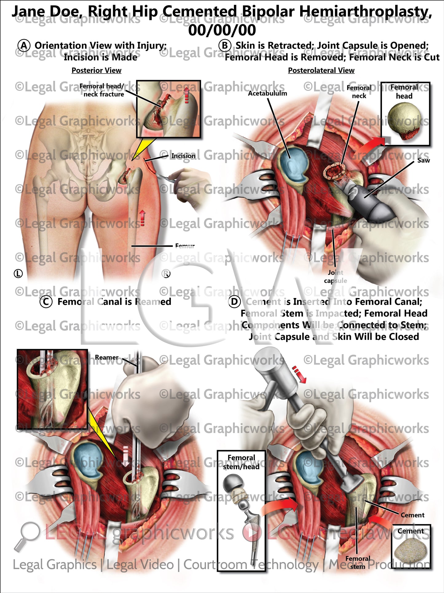 Right Hip Cemented Bipolar Hemiarthroplasty
