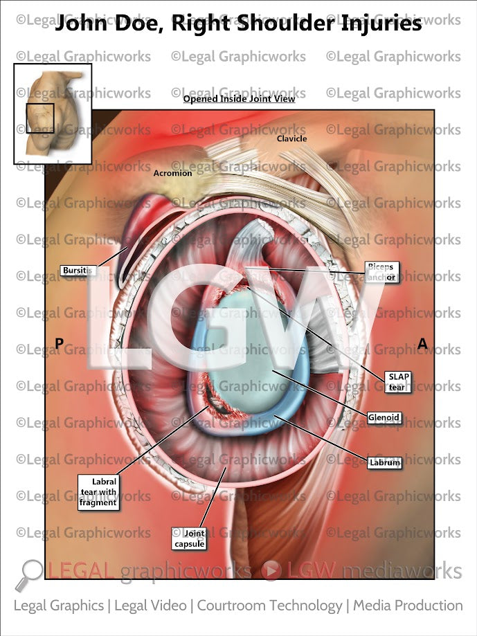 Right Shoulder Injuries