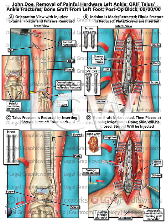 Removal of Painful Hardware Left Ankle; ORIF Talus/Ankle Fractures; Bone Graft From Left Foot; Post-Op Block