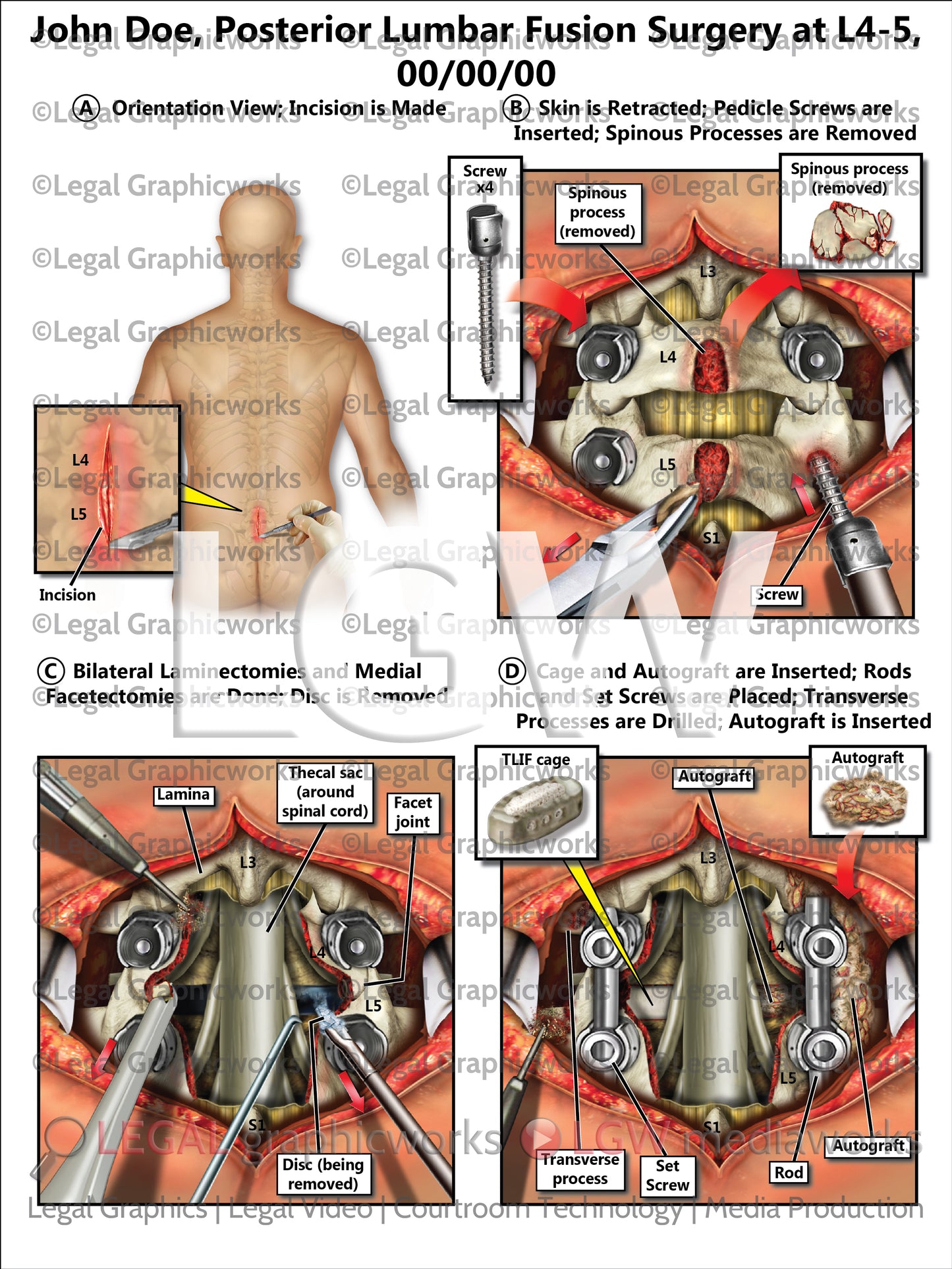 Posterior Lumbar Fusion Surgery at L4-5