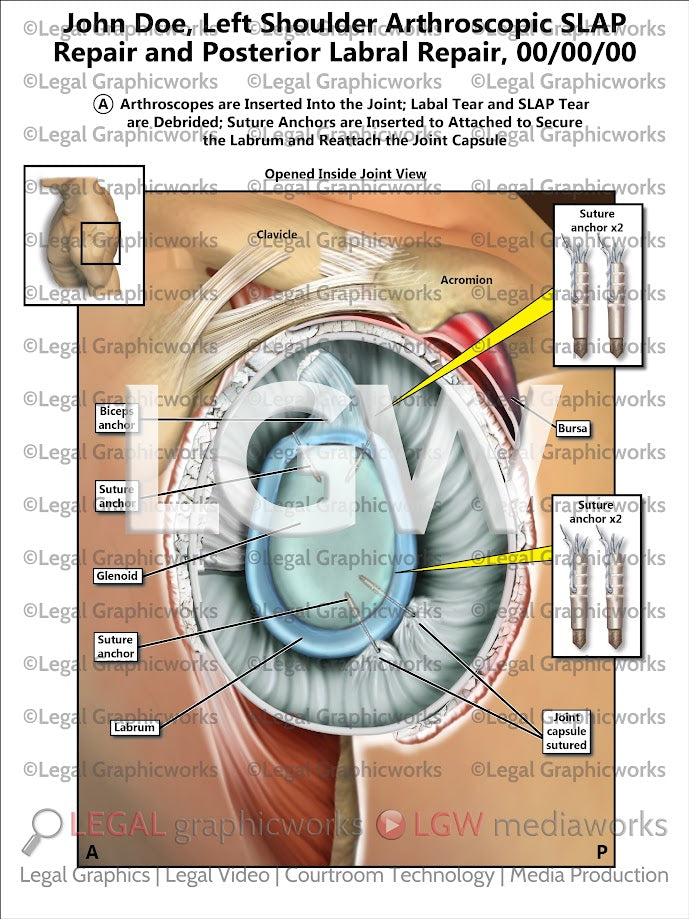 Left Shoulder Arthroscopic SLAP Repair and Posterior Labral Repair