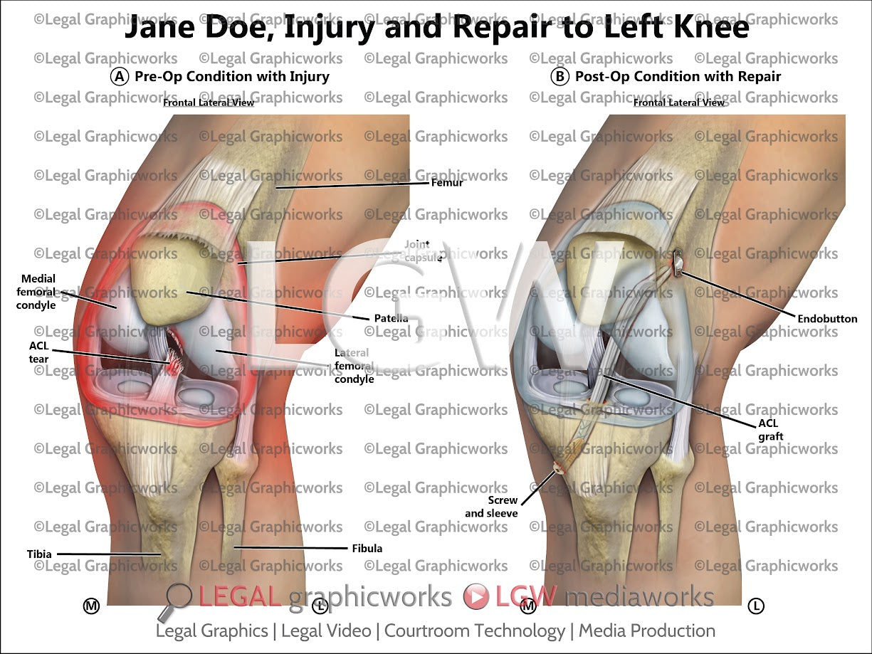 Injury and Repair to Left Knee