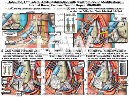 Left Lateral Ankle Stabilization with Brostrom-Gould Modification; Internal Brace; Peroneal Tendon Repair