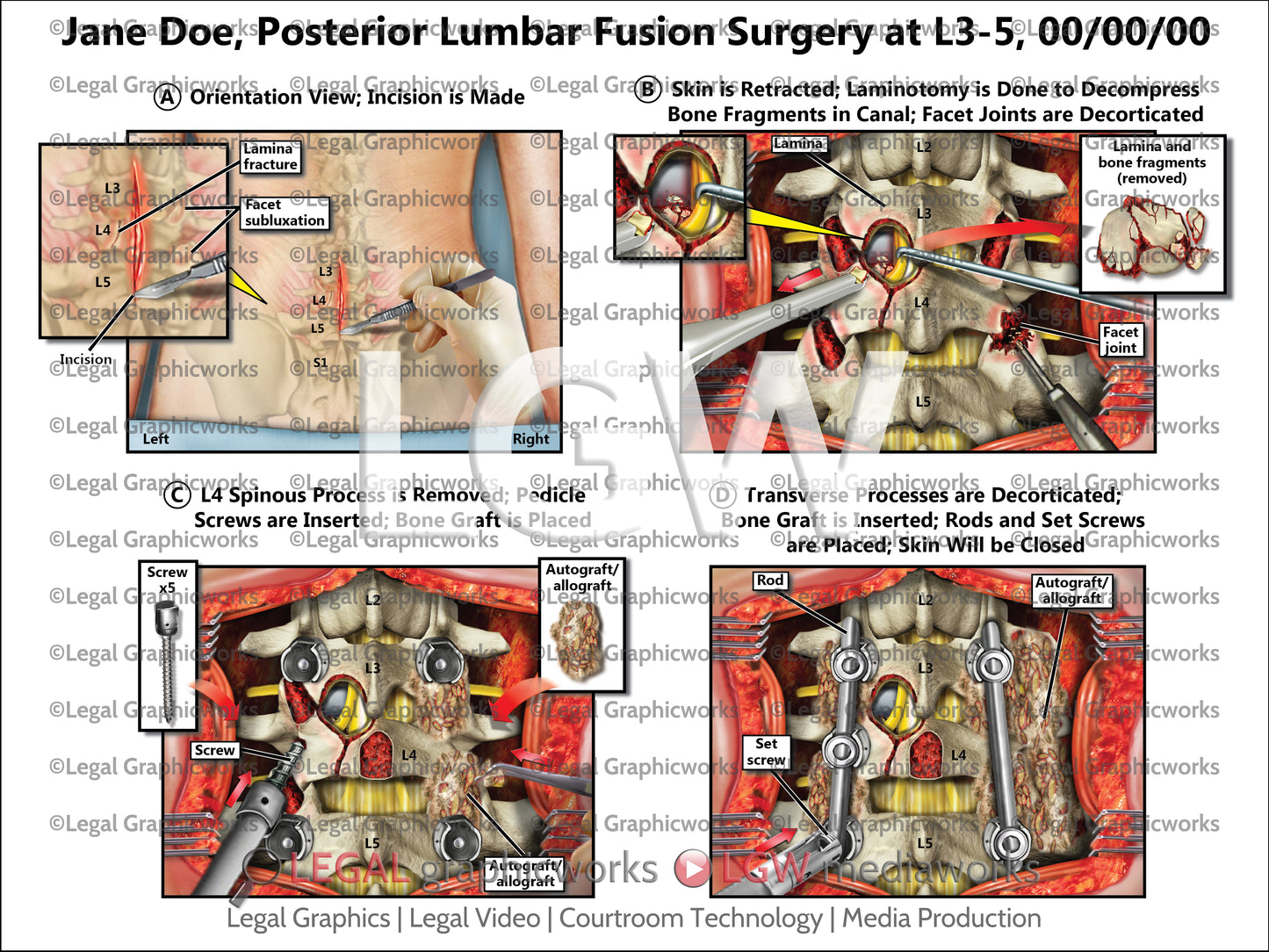 Posterior Lumbar Fusion Surgery at L3-5
