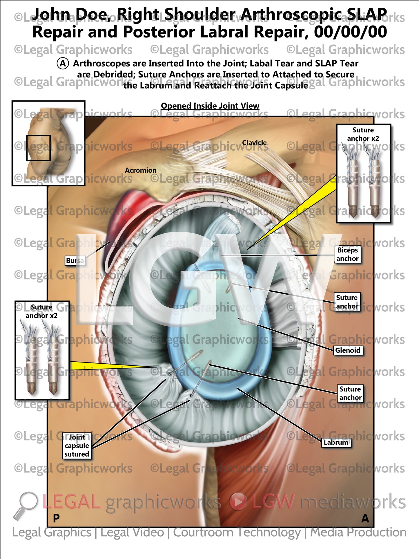 Right Shoulder Arthroscopic SLAP Repair and Posterior Labral Repair