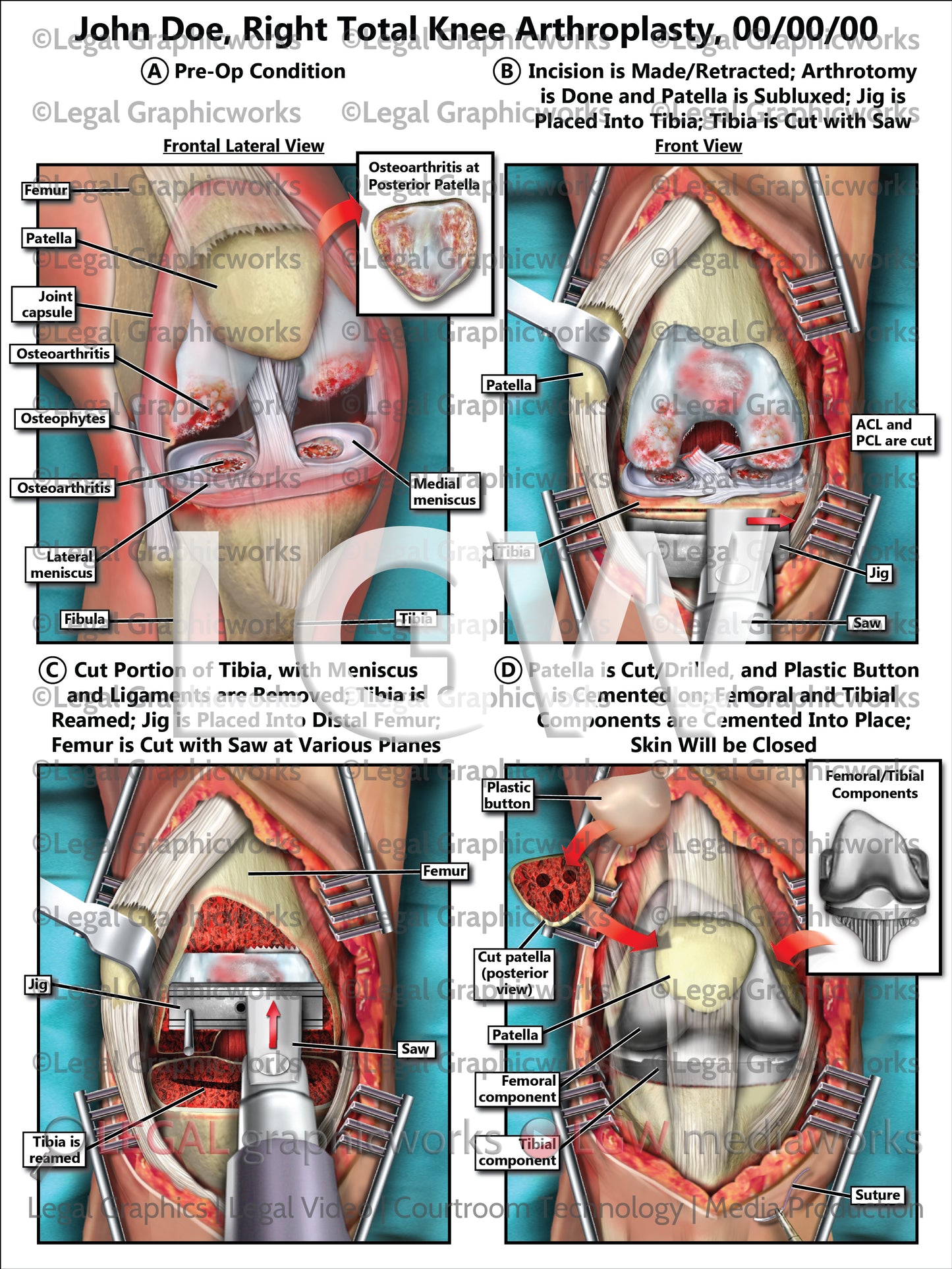 Right Total Knee Arthroplasty