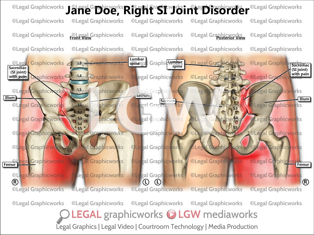 Right SI Joint Disorder