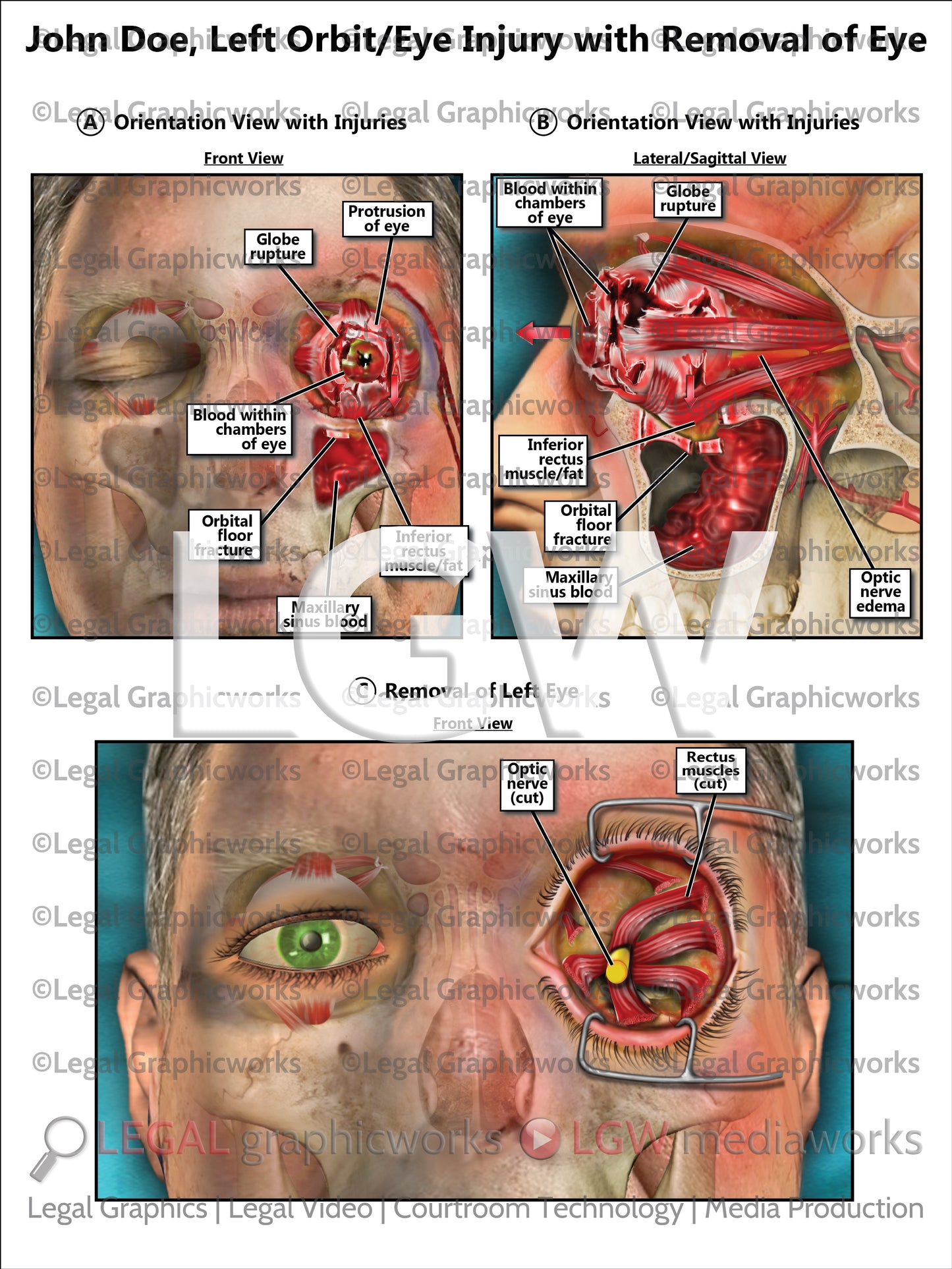 Left Orbit/Eye Injury with Removal of Eye