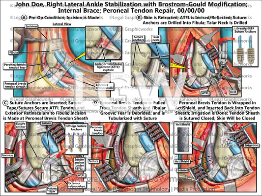 Right Lateral Ankle Stabilization with Brostrom-Gould Modification; Internal Brace; Peroneal Tendon Repair