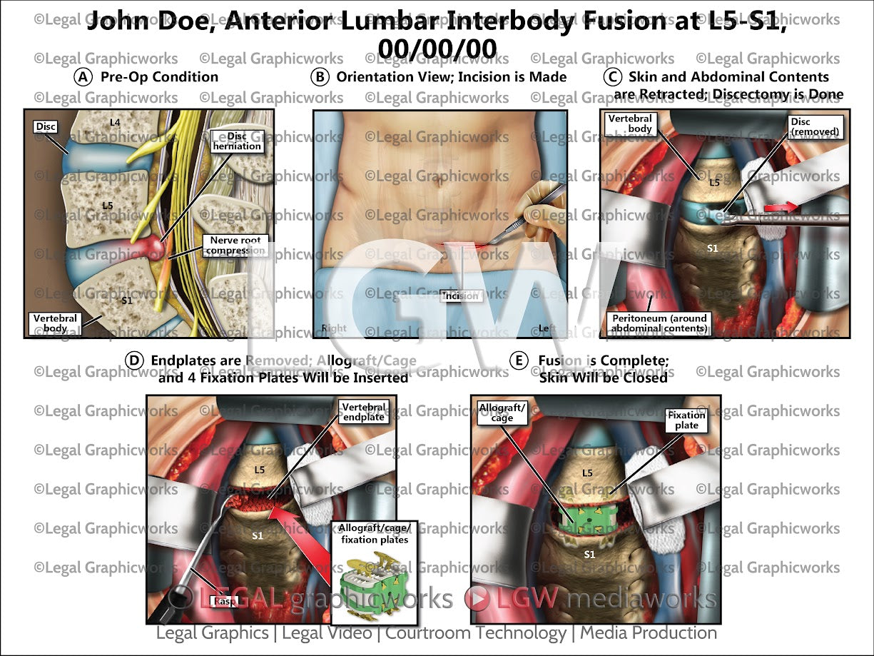Anterior Lumbar Interbody Fusion at L5-S1