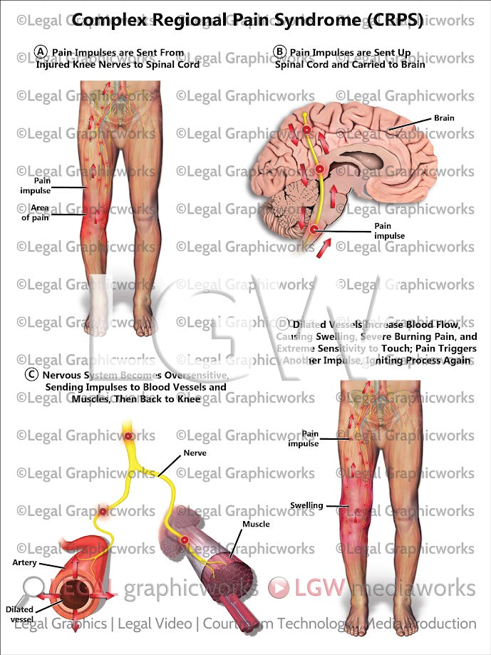Complex Regional Pain Syndrome (CRPS)