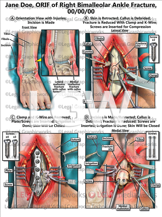 ORIF of Right Bimalleolar Ankle Fracture
