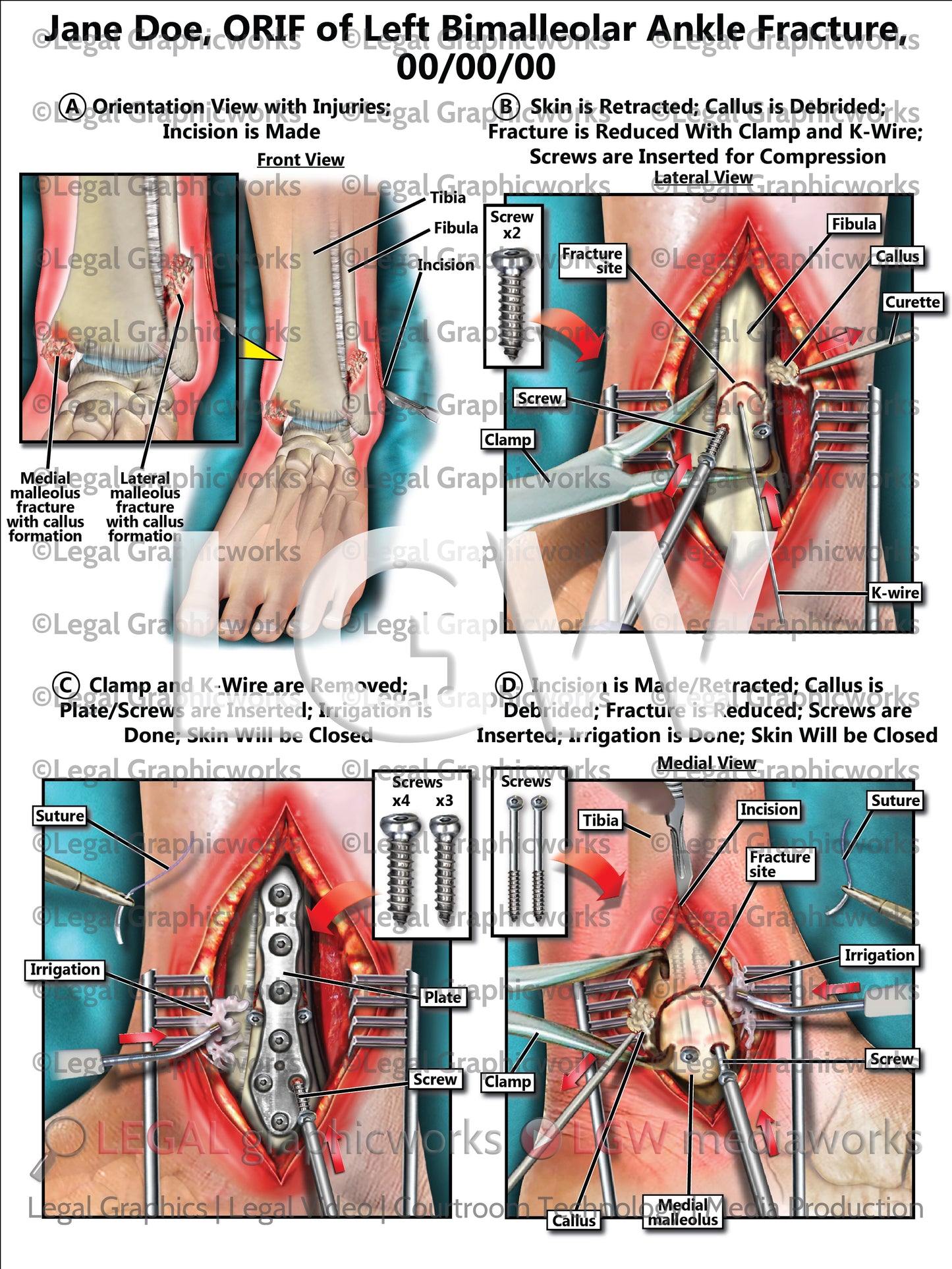 ORIF of Left Bimalleolar Ankle Fracture