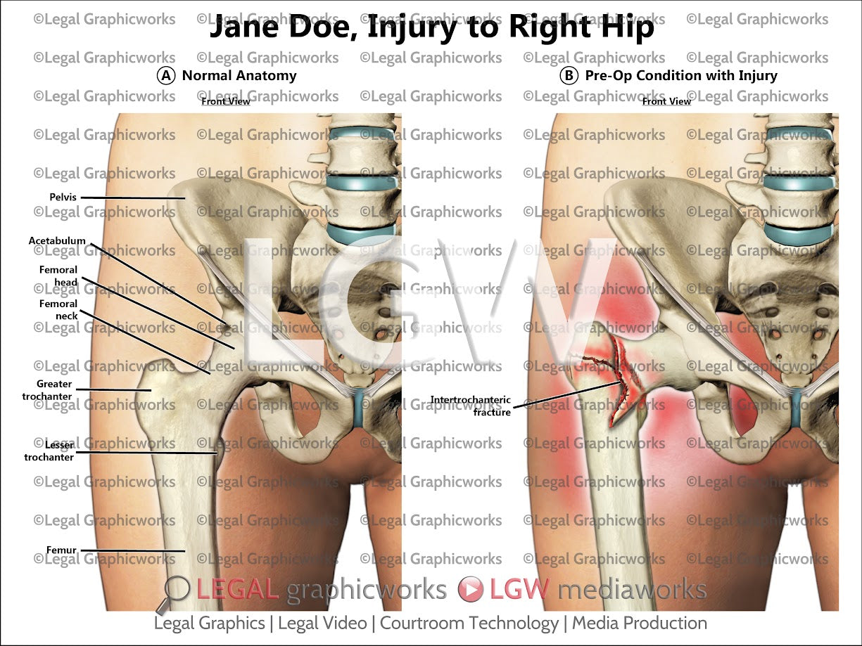 Injury to Right Hip