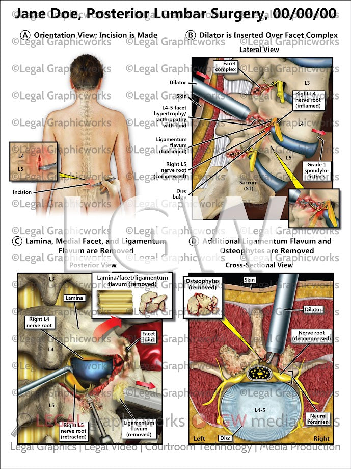 Posterior Lumbar Surgery