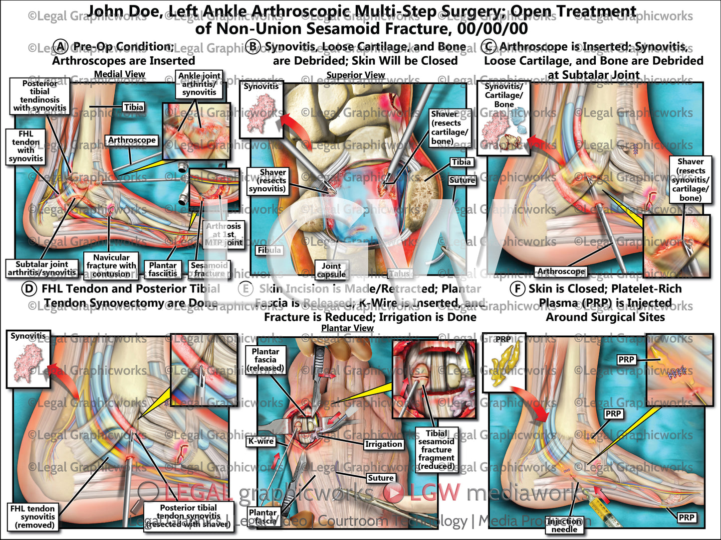 Left Ankle Arthroscopic Multi-Step Surgery; Open Treatment of Non-Union Sesamoid Fracture