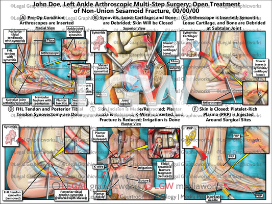 Left Ankle Arthroscopic Multi-Step Surgery; Open Treatment of Non-Union Sesamoid Fracture