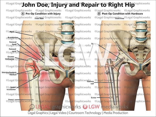 Injury and Repair to Right Hip