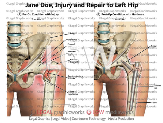 Injury and Repair to Left Hip