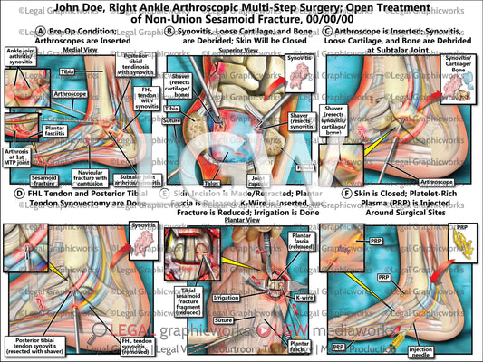 Right Ankle Arthroscopic Multi-Step Surgery; Open Treatment of Non-Union Sesamoid Fracture