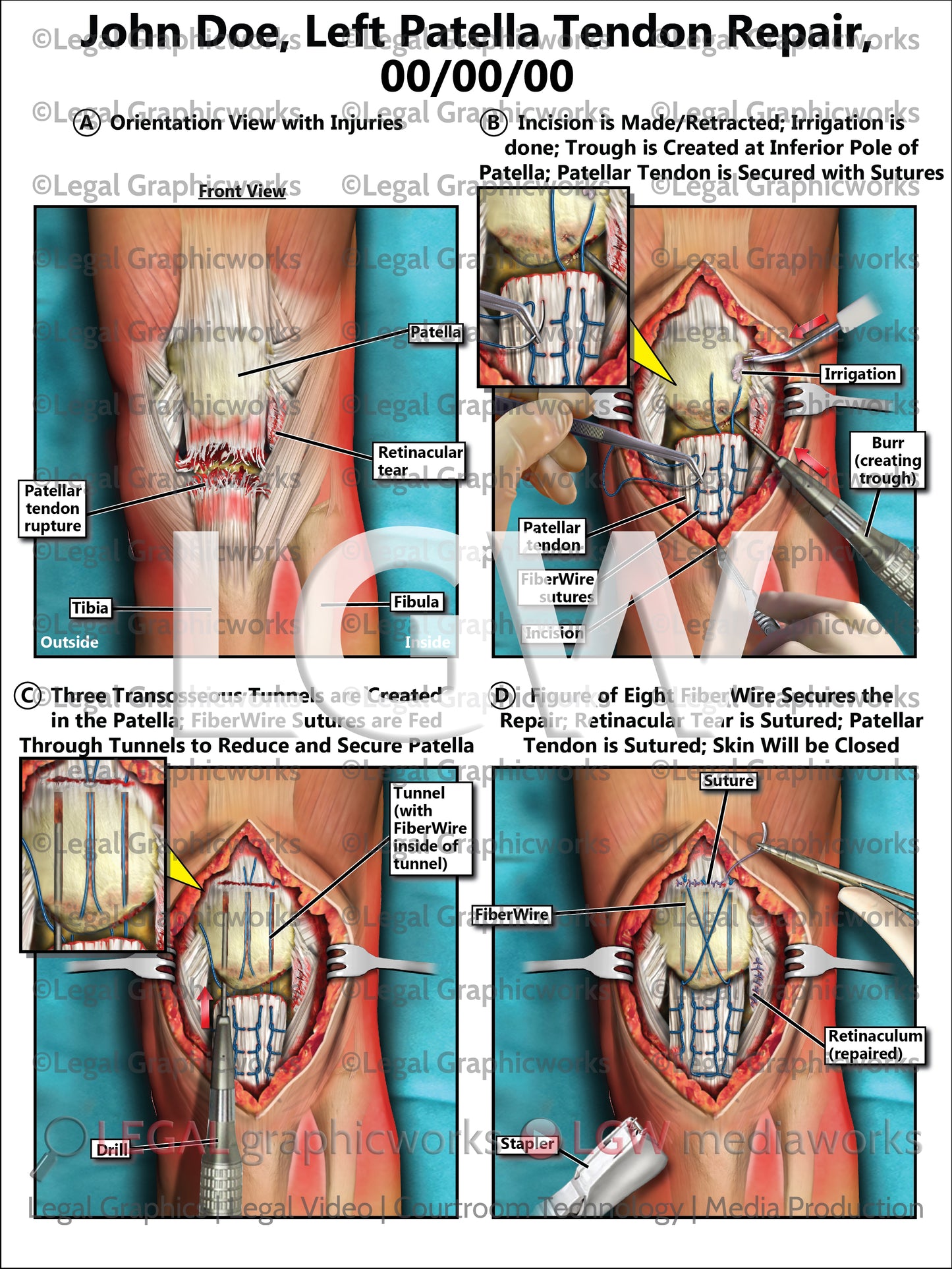 Left Patella Tendon Repair