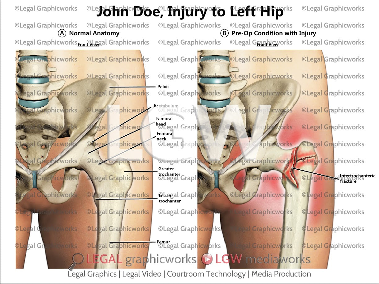 Injury to Left Hip