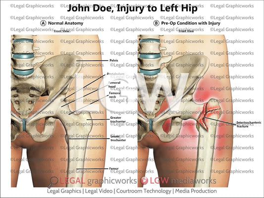 Injury to Left Hip