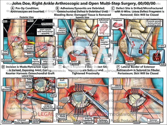 Right Ankle Arthroscopic and Open Multi-Step Surgery