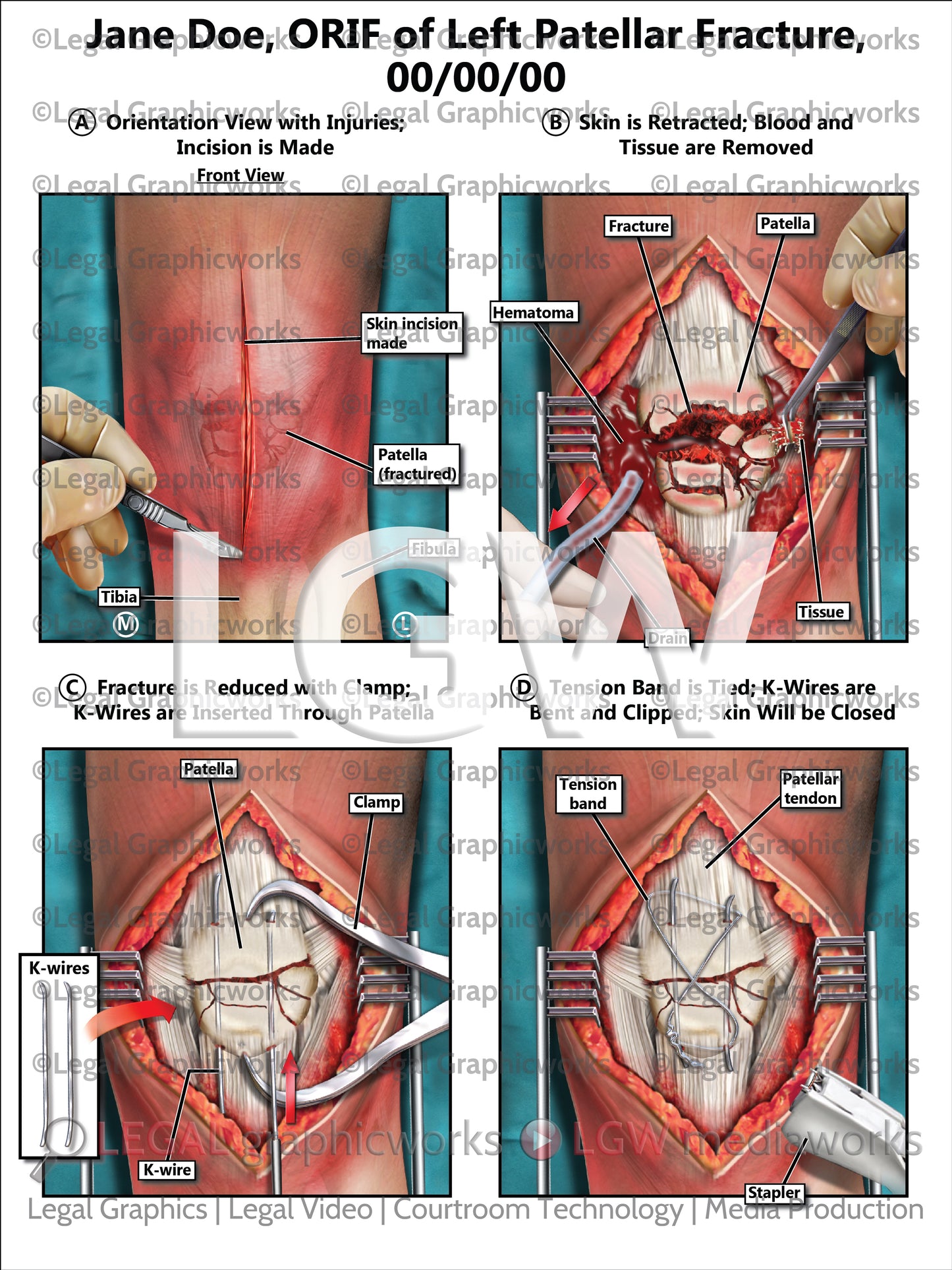 ORIF of Left Patellar Fracture