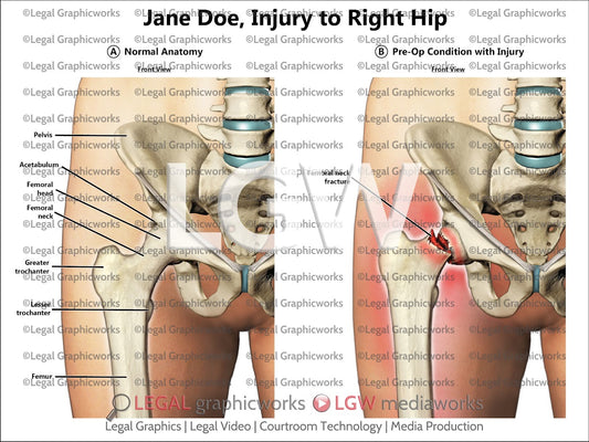 Injury to Right Hip