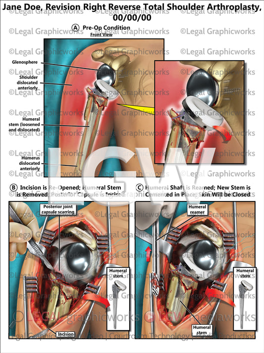 Revision Right Reverse Total Shoulder Arthroplasty