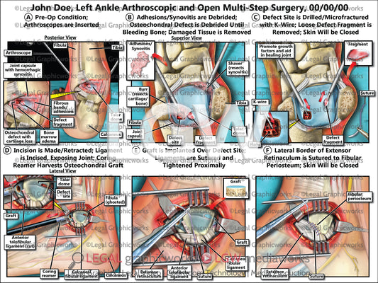 Left Ankle Arthroscopic and Open Multi-Step Surgery