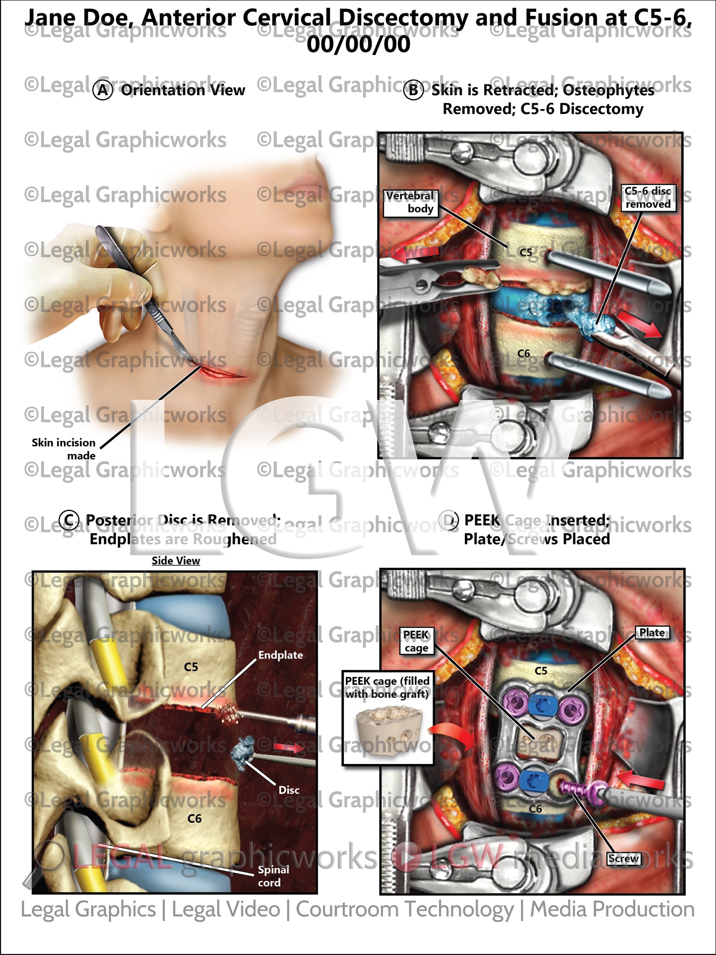 Anterior Cervical Discectomy and Fusion at C5-6