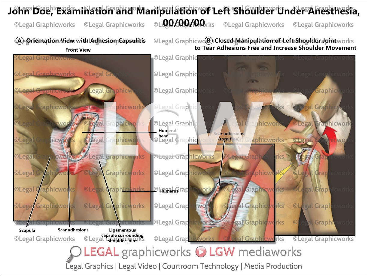 Examination and Manipulation of Left Shoulder under Anesthesia